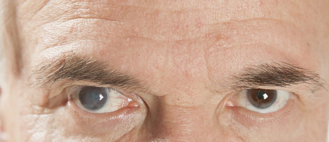 Cataracts Awareness: What You Need to Know